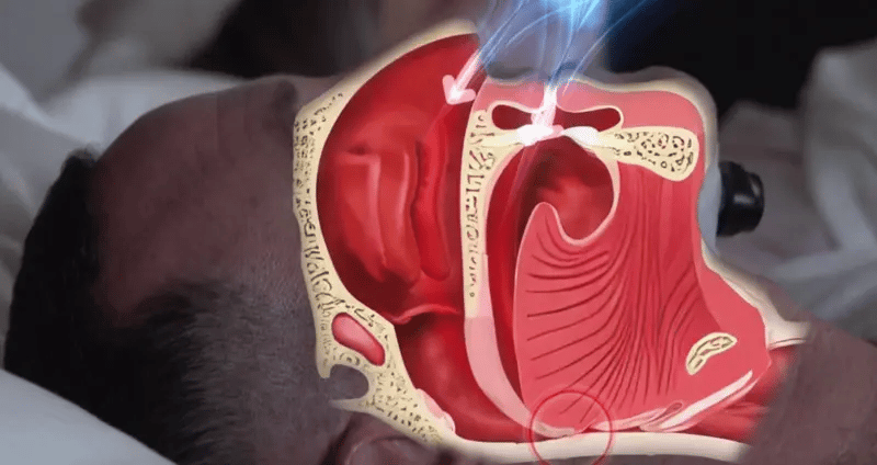 RoncoZero™ — tecnologia comprovada, sem truques